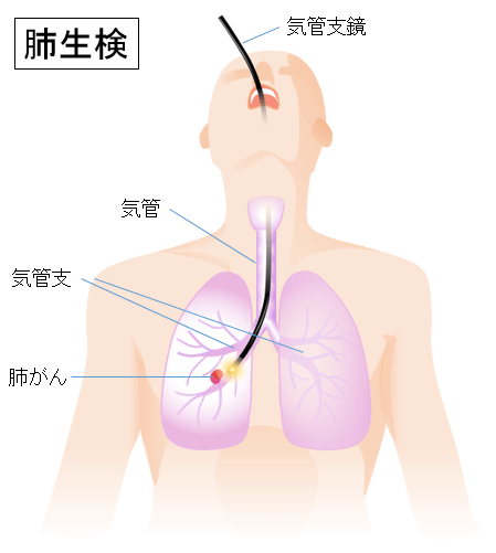 肺生検